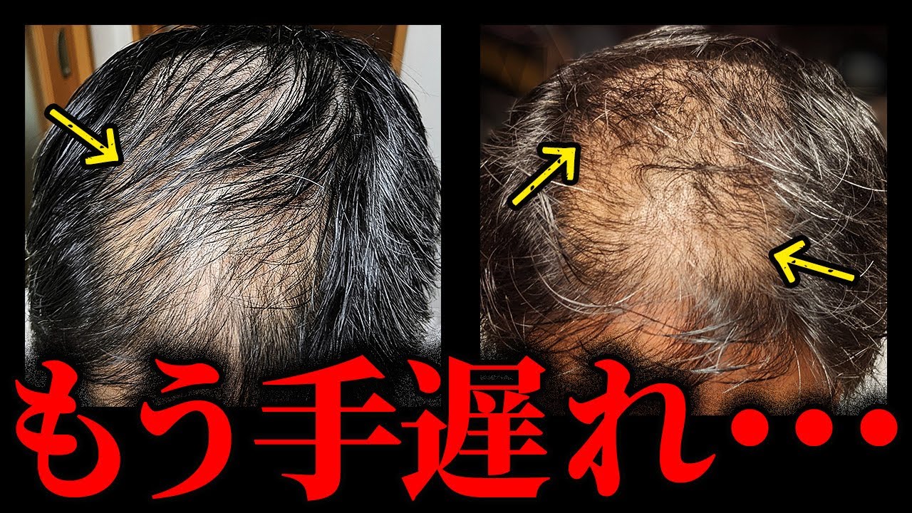 【悲劇】AGA治療で後悔する前に見て！薄毛対策のタイムリミット