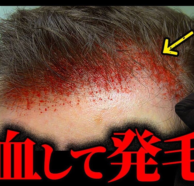 Aga 治療 ダーマローラー 育毛 ダーマローラー hc902 育毛 頭皮活性化 ヘアローション 正規 ドイツ 医療 スカルプ ケア 発毛 脱毛 薄毛 美容鍼 鍼灸 爆買