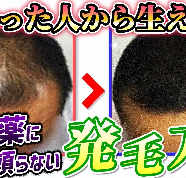 ビフォーアフター】20年間の薄毛が〇〇で解消！ | 大宮で発毛・薄毛