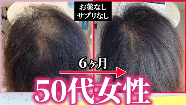 【プロの発毛方法】30年悩んだ薄毛がたった6ヶ月で大変身！