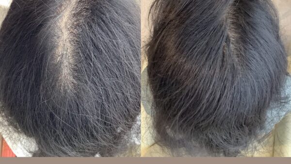 40代女性がお薬を使わずに薄毛もくせ毛も改善されました✨