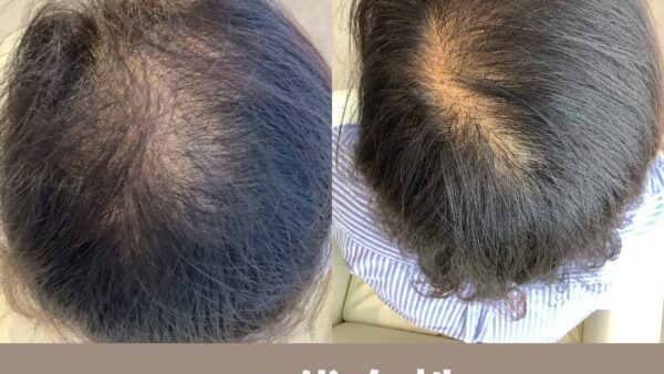 50代女性のお客様が8か月で薄毛を改善されました✨