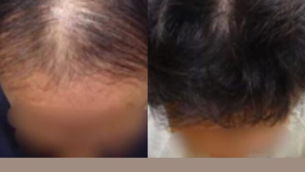 40代男性のお客様が10か月げ薄毛改善！お薬を使わない発毛とは？