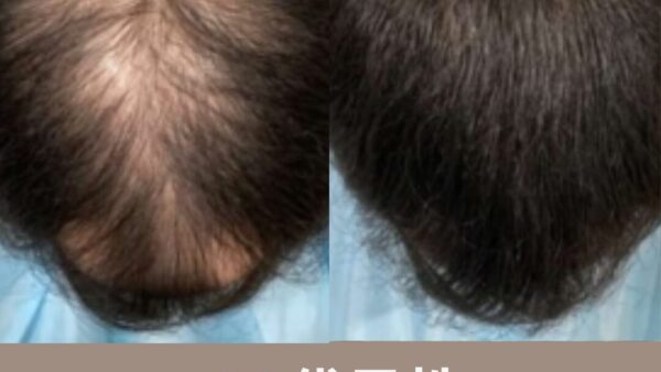 【30代男性の発毛症例】7年間悩んだ薄毛がわずか5ヶ月で改善！