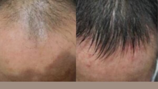 40代男性のお客様】10ヵ月で前頭部・頭頂部の発毛を実感！